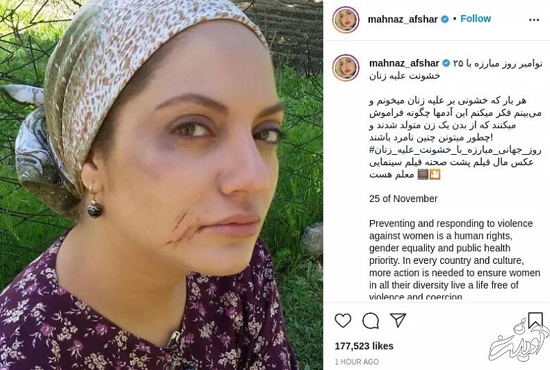 عکسی که مهناز افشار از صورت کبودش منتشر کرد